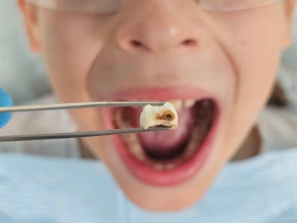 Best Emergency Treatment for Dental Infections or Abscesses in Aviston, IL