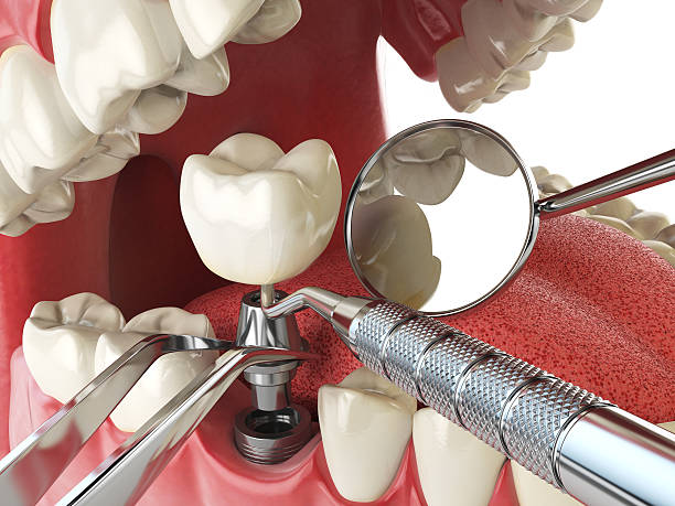Best Emergency Treatment for Dental Infections or Abscesses in Aviston, IL